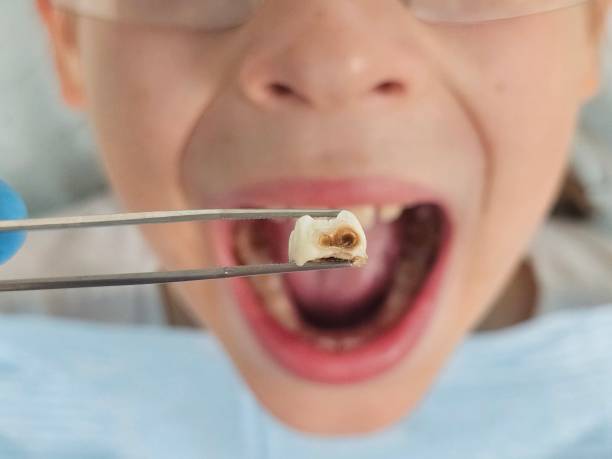 Best Emergency Root Canal Treatment in Commerce, OK